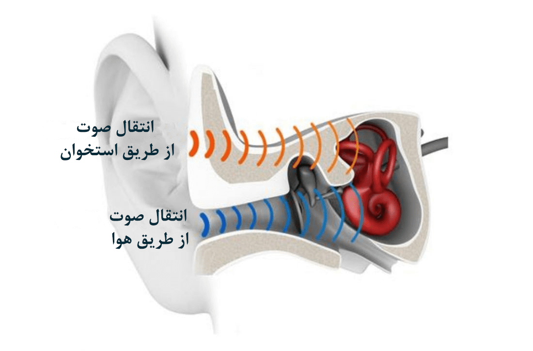 سمعک استخوانی