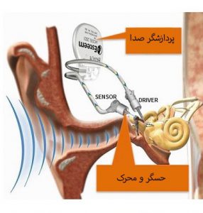 دستگاه کاملاً قابل کاشت گوشت میانی استیم از شرکت Envoy Medical آمریکا